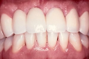 Advanced periodontal disease - after